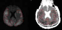 Volumetry of bilateral cortical ischemiaon DWI (left) and ADC (right)